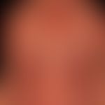 Systemic lupus erythematosus: chronic, UV-provoked, locally constant maculo-papular exanthema; co...