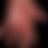 Differential diagnosis "hand dermatitis" - present chronic (tumorous) skin changes within the sco...