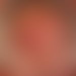 Primary cutaneous follicular center lymphoma: For several years training of surface smooth, painl...