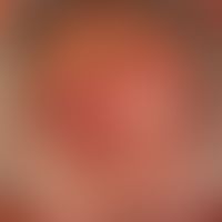 Primary cutaneous follicular center lymphoma: For several years training of surface smooth, painl...