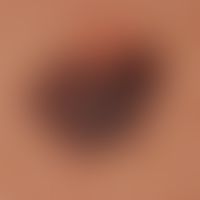 Melanoma, malignant, superficially spreading: superficially spreading malignant melanoma. Enlarge...