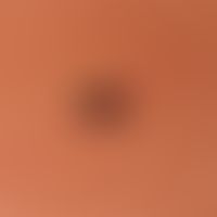 Melanom, malignes, superfiziell spreitendes:&nbsp; superfiziell spreitendes malignes Melanom. Ver...