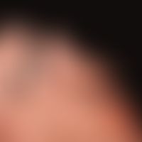 Melanoma malignes acrolentiginous: Brown "spot" on the left small toe that has existed for many y...