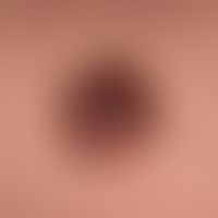 Melanoma superficially spreading: Plaque which is no longer symmetrical and smooth on the surface...