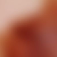Melanom malignes, superfiziell spreitendes: Auflichtmikroskpie des Randzonenbereichs.&nbsp; Anged...