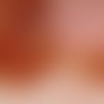 Melanom, malignes, superfiziell spreitendes. Auflichtmikroskopie: Randbereich, Clark Level III, T...