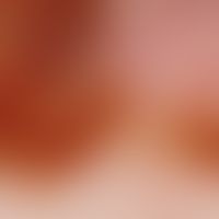 Melanom, malignes, superfiziell spreitendes. Auflichtmikroskopie: Randbereich, Clark Level III, T...