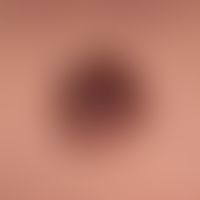 Melanom, superfiziell spreitendes: nicht mehr symmetrische, oberflächglatte Plaque mit mehreren l...