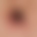 Melanoma, malignant, nodular: Rapid growth in thickness in the last few months "I have already we...