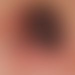 Melanoma, malignant, nodular: Rapid growth in thickness in the last few months. "I have already w...