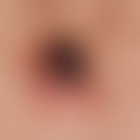 Melanoma malignant "type primary nodular melanoma": advanced nodular malignant melanoma with clea...