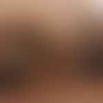 Melanom malignes akrolentiginöses: Auflichtmikroskpie der Nagelfalz mit tumoröser Infiltration.&n...