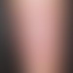 Erythema migrans:&nbsp; etwa 2-3 Monate alter Befund mit langsamer peripherer Ausdehnung . Schmer...