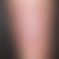 Erythema migrans:&nbsp; etwa 2-3 Monate alter Befund mit langsamer peripherer Ausdehnung . Schmer...