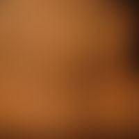 Acanthosis nigricans benigna: unscharf begrenzte braun-schwarze Flecken und Plaques. Die Plaques ...