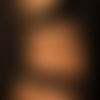 Acanthosis nigricans (benigna): generalized clinical picture with large, blurred, symptomless, su...