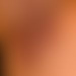 Hidradenitis suppurativa: chronically persistent, brownish or reddish livid scarring in the right...