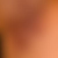 Hidradenitis suppurativa: chronically persistent, brownish or reddish livid scarring in the right...