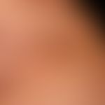 Acne inversa:&nbsp; Detailaufnahme der Umgebung mit multiplen, flachen und eingezogenen Narben, e...