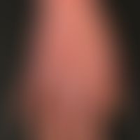 Chronische Handdermatitis: flächige chronische Dermatitis der Handrücken und der Fingerzwischenrä...