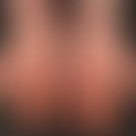 Chronische Handdermatitis: flächige chronische Dermatitis der Palmae. Mäßiggradige Lichenifikatio...