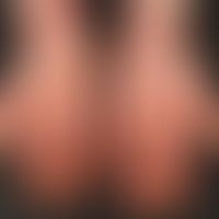 Chronische Handdermatitis: flächige chronische Dermatitis der Palmae. Mäßiggradige Lichenifikatio...
