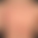 Kontaktdermatitis toxische: 42 Jahre alter Patient, der nach zufälligem Kontakt mit einer ätzende...