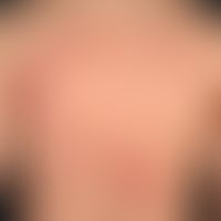 Kontaktdermatitis toxische: 42 Jahre alter Patient, der nach zufälligem Kontakt mit einer ätzende...