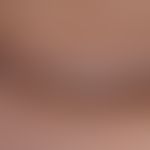 Vitiligo: infestation of the eyelids and the adjacent cheek area. spot-shaped repigmentation. def...