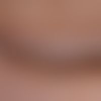 Vitiligo: Befall der Lider und des angrenzenden Wangebereichs. Fleckförmige Repigmentierung. Per ...