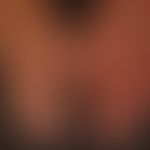 Acrodermatitis chronica atrophicans: livid, blurred, changeable colored erythema of the left hand...