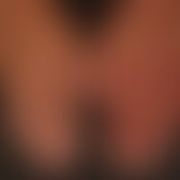 Acrodermatitis chronica atrophicans: livid, blurred, changeable colored erythema of the left hand...