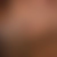 Acne conglobata: Detailausschnitt. Tief eingesunkene Narbe als Ausheilungszustand der Einzelefflo...