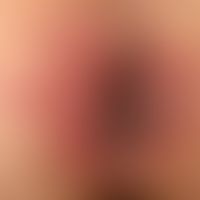 Differenzialdiagnose "anale Dermatitis" 

Diagnose:&nbsp;vorliegend "Condylomata acuminata". Chro...