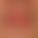 Cheilitis glandularis: distinct and at times painful swelling of the upper lip with selective pro...