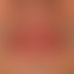 Cheilitis glandularis: distinct and at times painful swelling of the upper lip with selective pro...