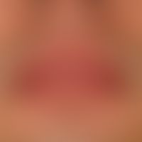 Cheilitis glandularis: distinct and at times painful swelling of the upper lip with selective pro...