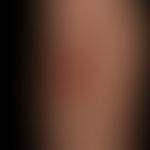 Nodules: on inflammatory plaque, several, occasionally ulcerated, red, rock-hard nodules. diagnos...