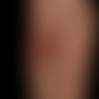 Nodules: on inflammatory plaque, several, occasionally ulcerated, red, rock-hard nodules. diagnos...