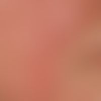 Demodex-Follikulitis: chronische beidseitige follikuläre Dermatitis mit flächiger Rötung. Vorbeka...