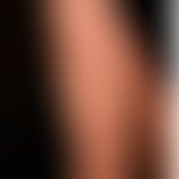 Lyme-Borreliose: Spätstadium: Bild der Acrodermatitis chronica atrophicans.
