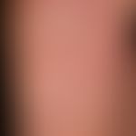 Psoriasis plantaris: dry keratotic plaque type, typical pattern of infection with extensive lamel...