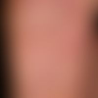 Psoriasis plantaris: trocken-keratotischer Plaque-Typ. Typisches Befallsmuster mit flächiger lame...