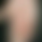 Psoriasis palmaris et plantaris: dry keratotic plaque type. chronic, sharply defined (wrist), ext...