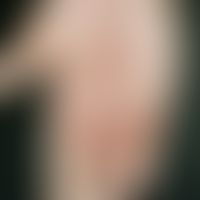 Psoriasis palmaris et plantaris: trocken-keratotischer Plaque-Typ. Chronische, scharf begrenzte (...