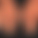 Psoriasis of the hands: dry keratotic plaque type with reddish, streaky, hyperkeratotic plaques, ...