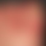 Dyshidrotische Dermatitis: chronisch rezidivierende Dermatitis an mehreren Zehen. Rezidivierende ...