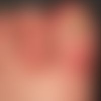 Dyshidrotische Dermatitis: chronisch rezidivierende Dermatitis an mehreren Zehen. Rezidivierende ...