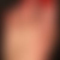 Dyshidrotische Dermatitis: chronisch rezidivierende,&nbsp; hyperkeratotische Dermatitis&nbsp; an ...