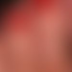Dyshidrotische Dermatitis: chronisch rezidivierende,&nbsp; hyperkeratotische Dermatitis an Händen...